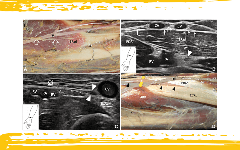 3. Nervio cutáneo lateral antebrazo.png